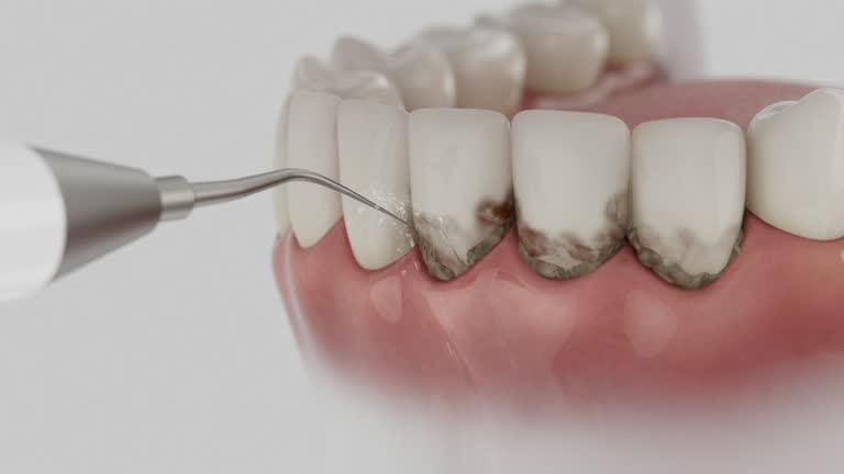 Trusted Wisdom Tooth Removal service in Montpelier, VT - Dentist Open Now